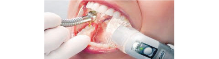 Is it Safe to Visit Your Dentist? Safety Measures in Beverly Hills Examined