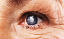 Cataracts and Dementia: Could There Be a Link?